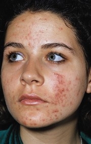 poza despre acnee vulgara